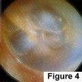 Acute Otitis Media - ENT Specialist