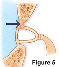 Hearing Loss Treatment - ENT Singapore